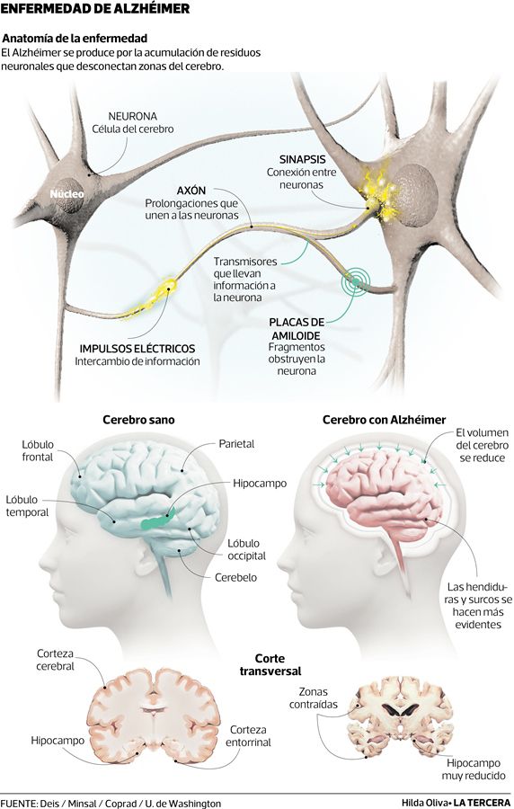 QUE-PASA-Alzhaimer.jpg