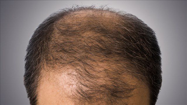 Could early balding signal heart trouble in men?