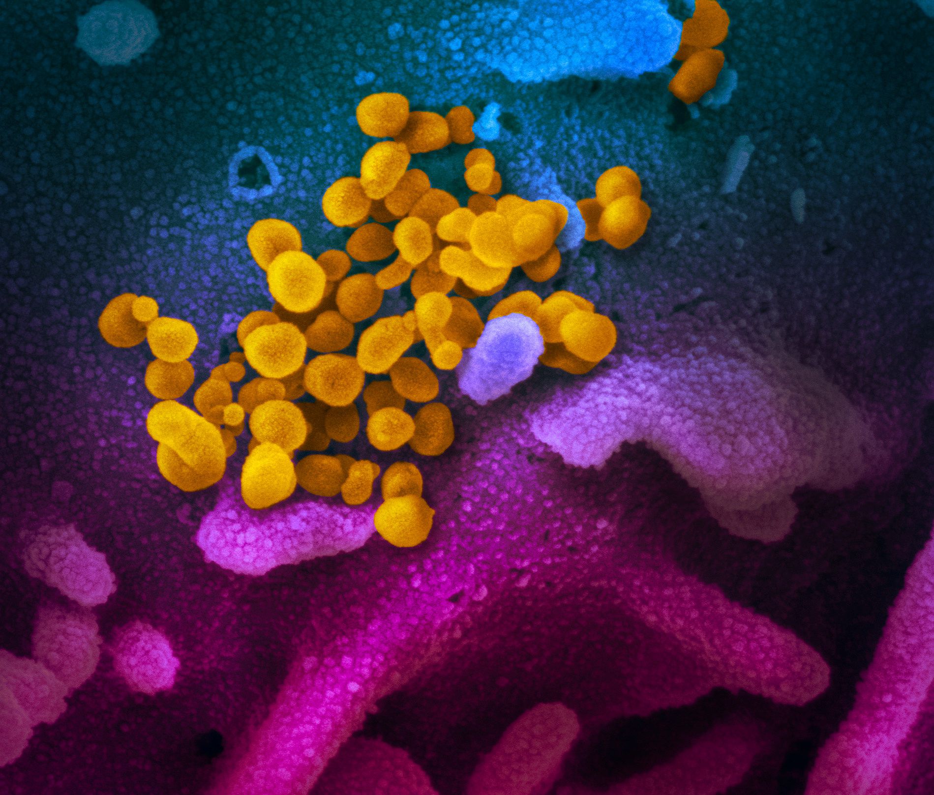 Scanning electron microscope image shows SARS-CoV-2 (yellow), also known as novel coronavirus