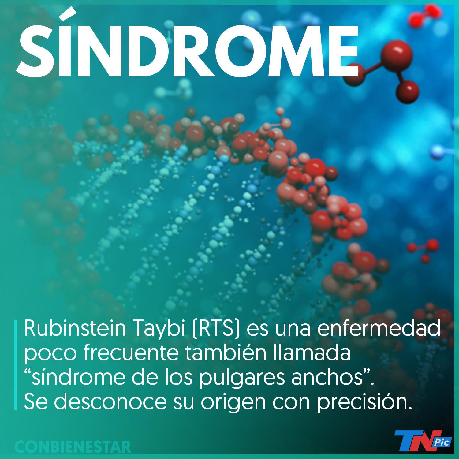 Infografía del Síndrome de Rubinstein-Taybi - Somosdisc@
