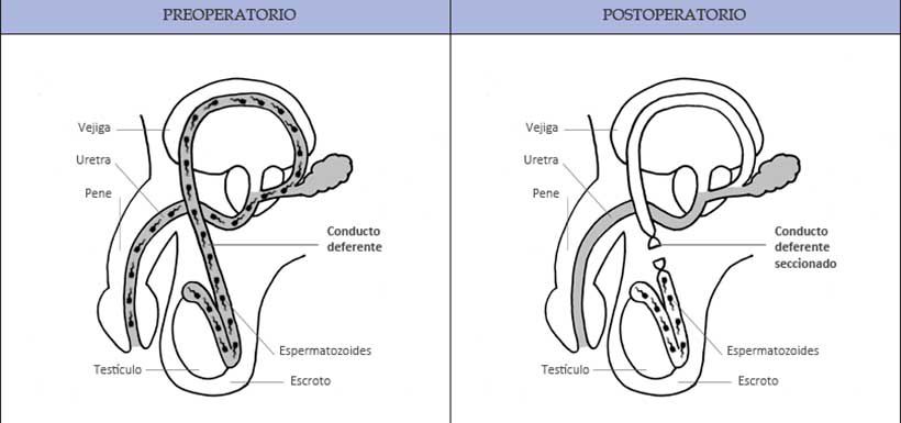 vasectomia1