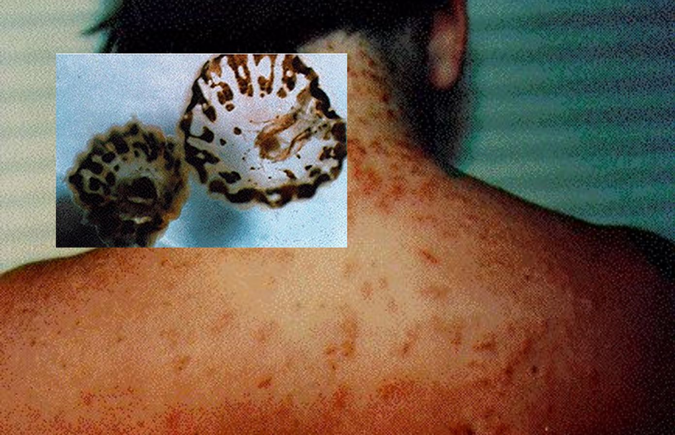 Itchy, stinging sea lice surface at Jersey Shore beaches 