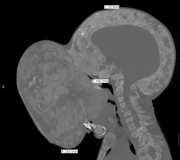 tumor-creciendo.jpg