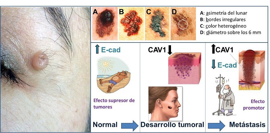 melanoma.jpg