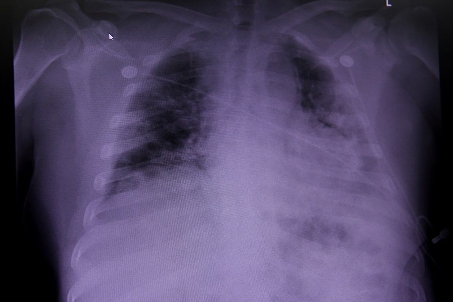 FILE PHOTO: An X-ray of a COVID-19 patient's lungs at United Memorial Medical Center in Houston